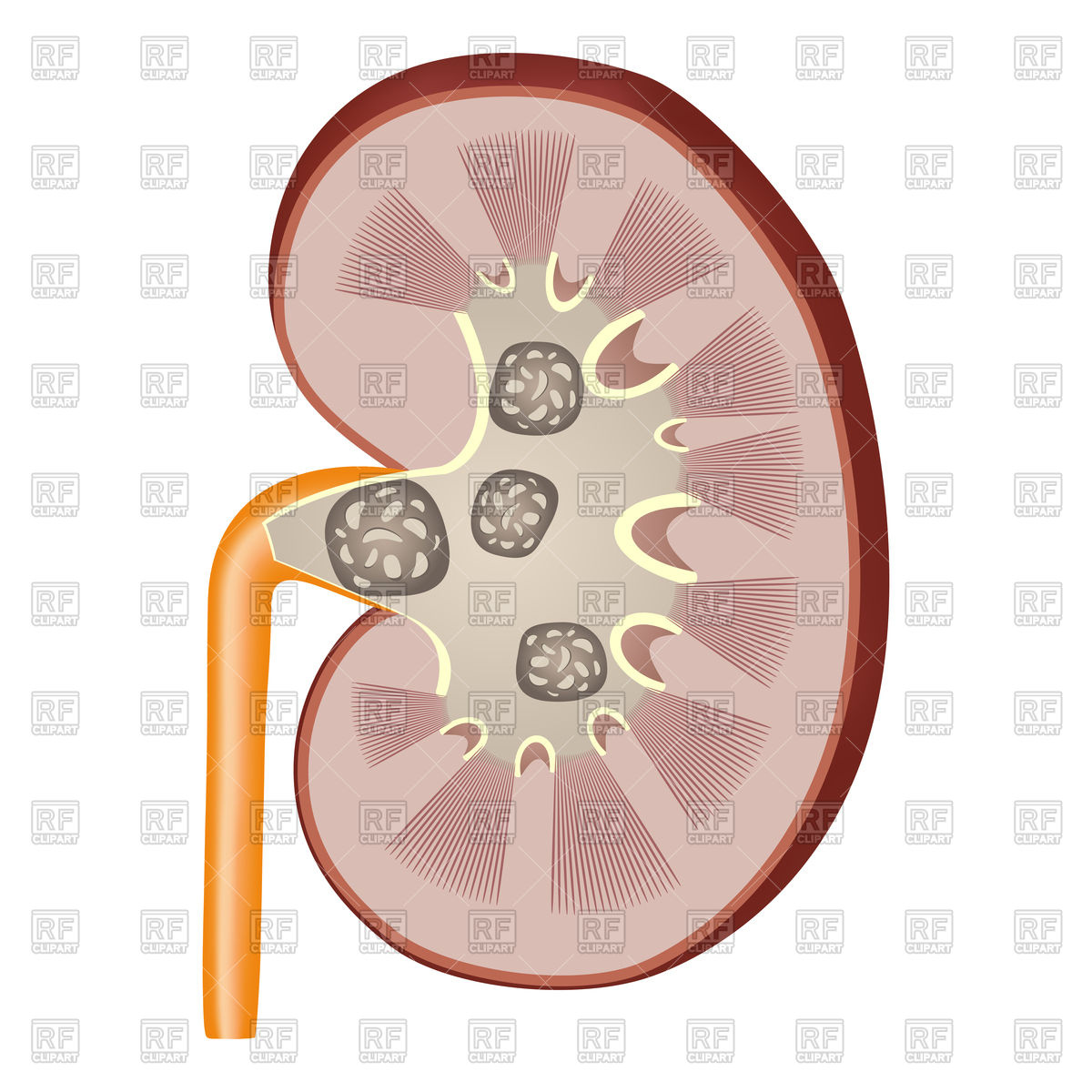 1200x1200 Detailed Anatomy Of Kidney Cross Section Showing Stones In Kidney