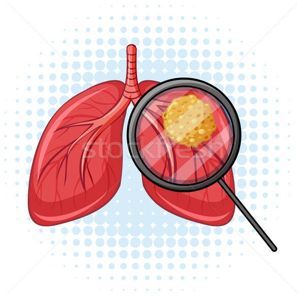 600x582 Cancer In Human Lungs Vector Illustration Daniel Cole