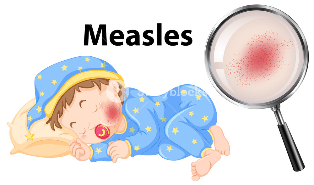 Measles Vector