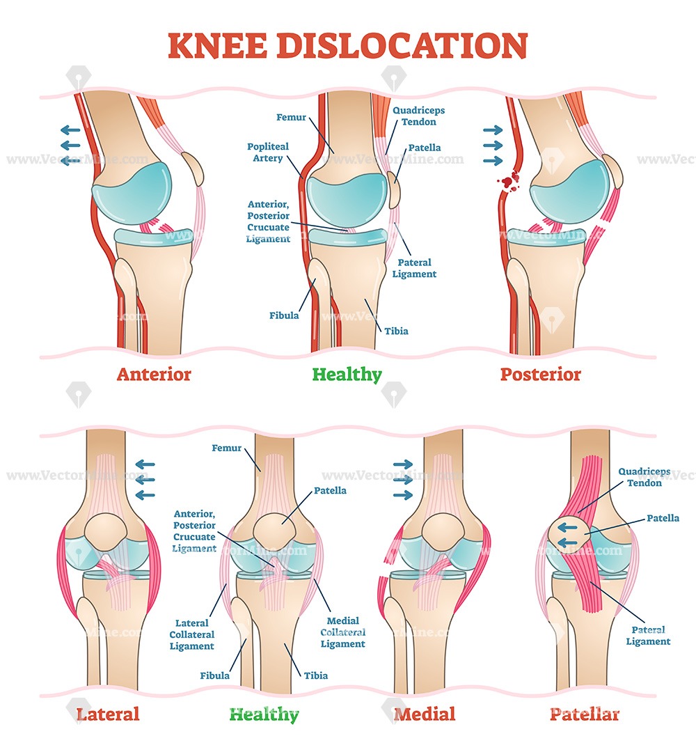 1000x1080 Knee Dislocations