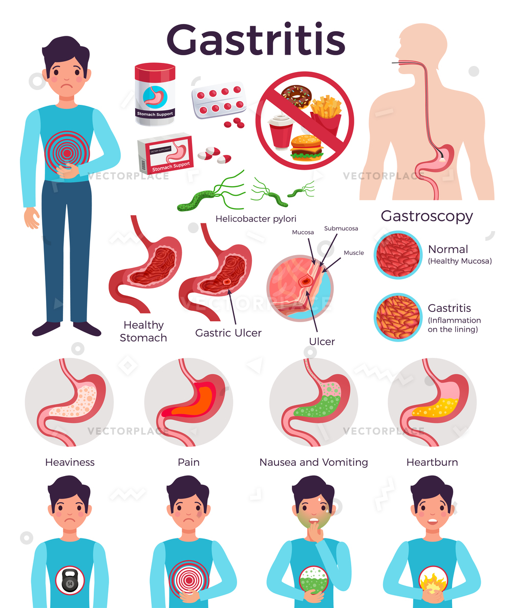 1000x1189 Gastritis Facts Flat Infographic Elements Disease Vector