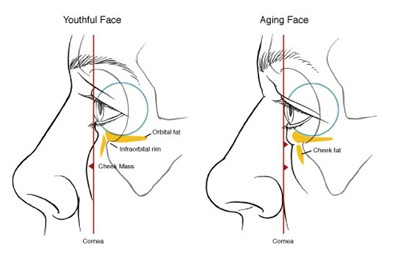 398x265 Prominent Eyes, Negative Vector, Round Eyes And Infraorbital Rim