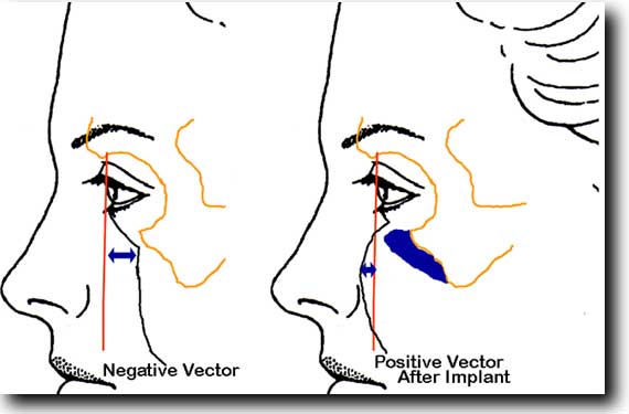 Negative Vector Eye