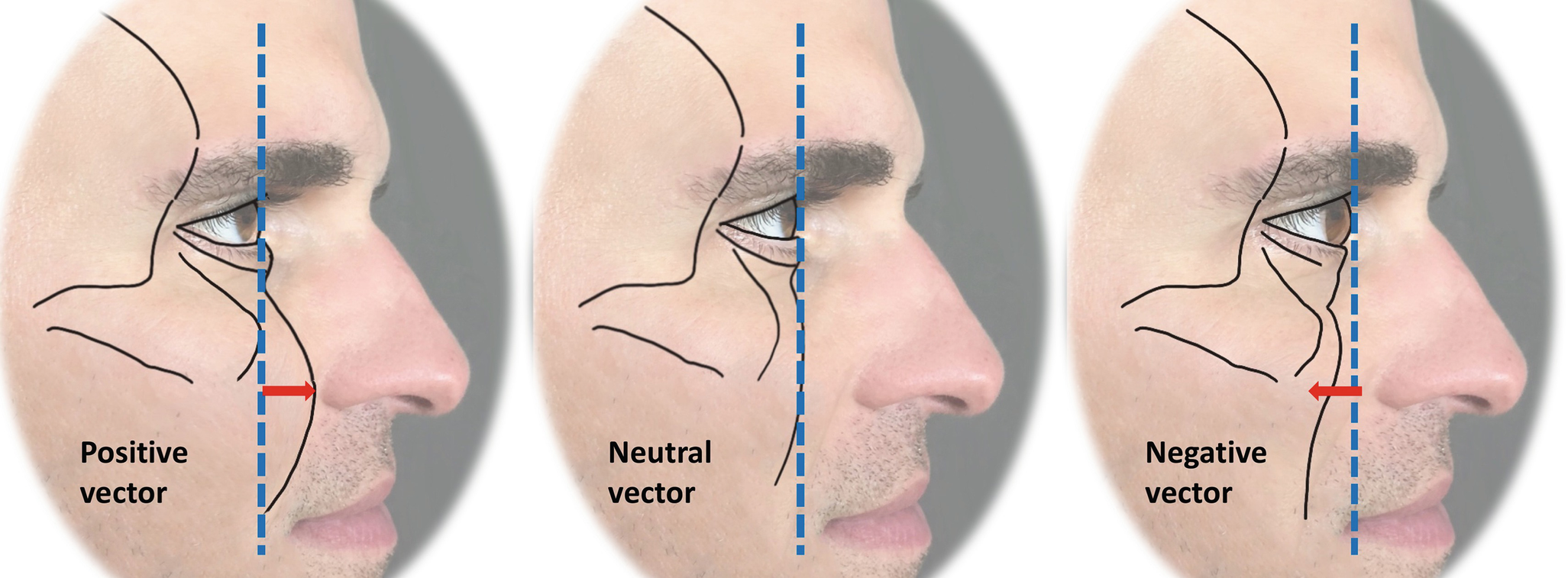 2053x757 Evaluation Of The Facelift Patient Springerlink