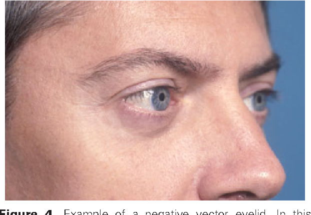 622x430 Figure From The Art Of Blepharoplasty