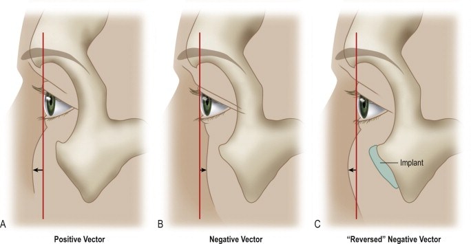 684x355 Alloplastic Augmentation To Improve Blepharoplasty And Midfacial