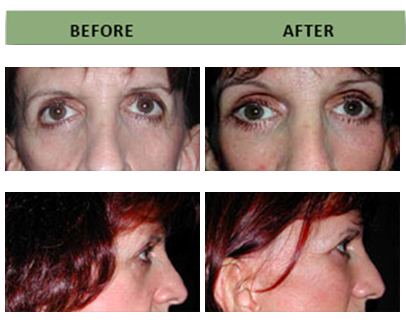 406x320 Infraorbital Rim Implants Boston Dr Michael J Yaremchuk, Md