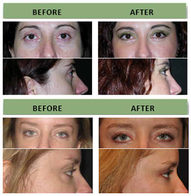 390x402 Infraorbital Rim Implants