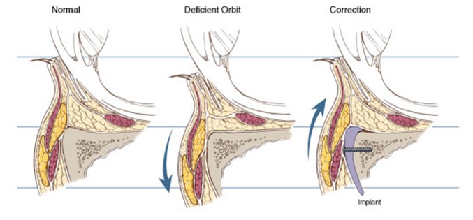 677x315 Prominent Eyes, Negative Vector, Round Eyes And Infraorbital Rim