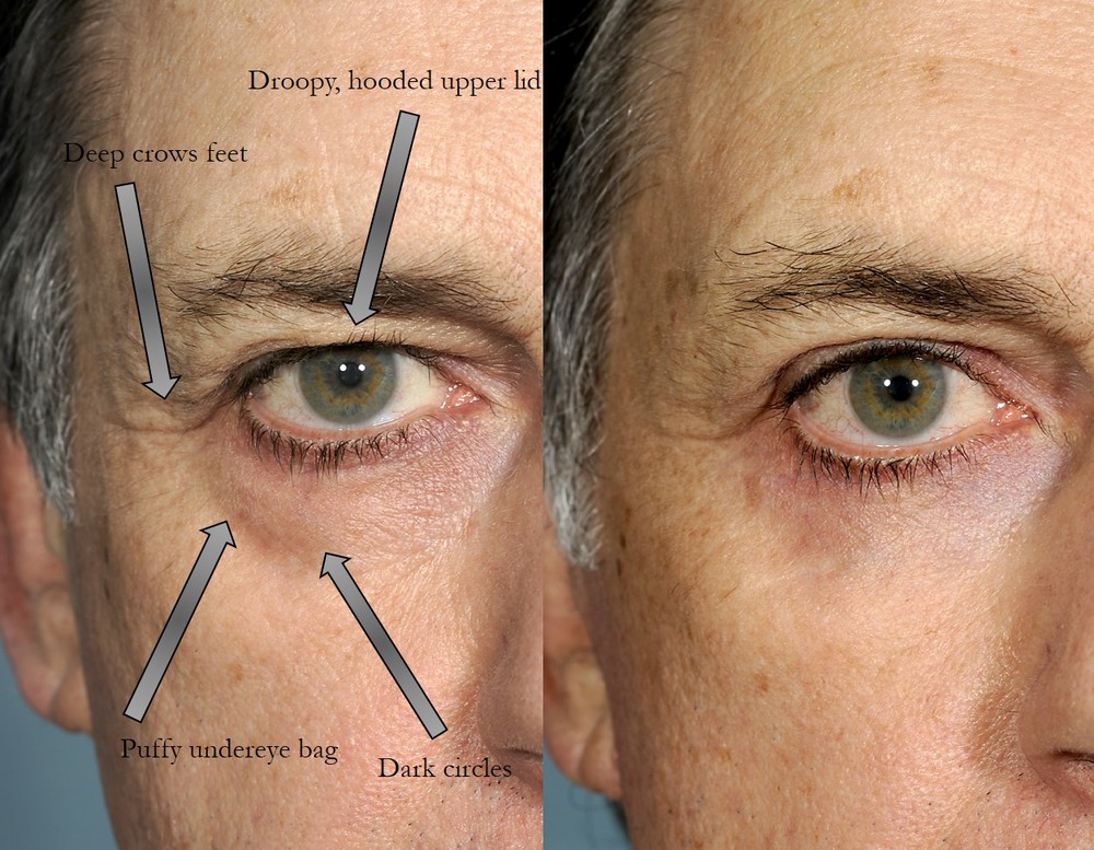 1000x777 Best Blepharoplasty In New York City Lara Devgan, Md, Mph, Facs