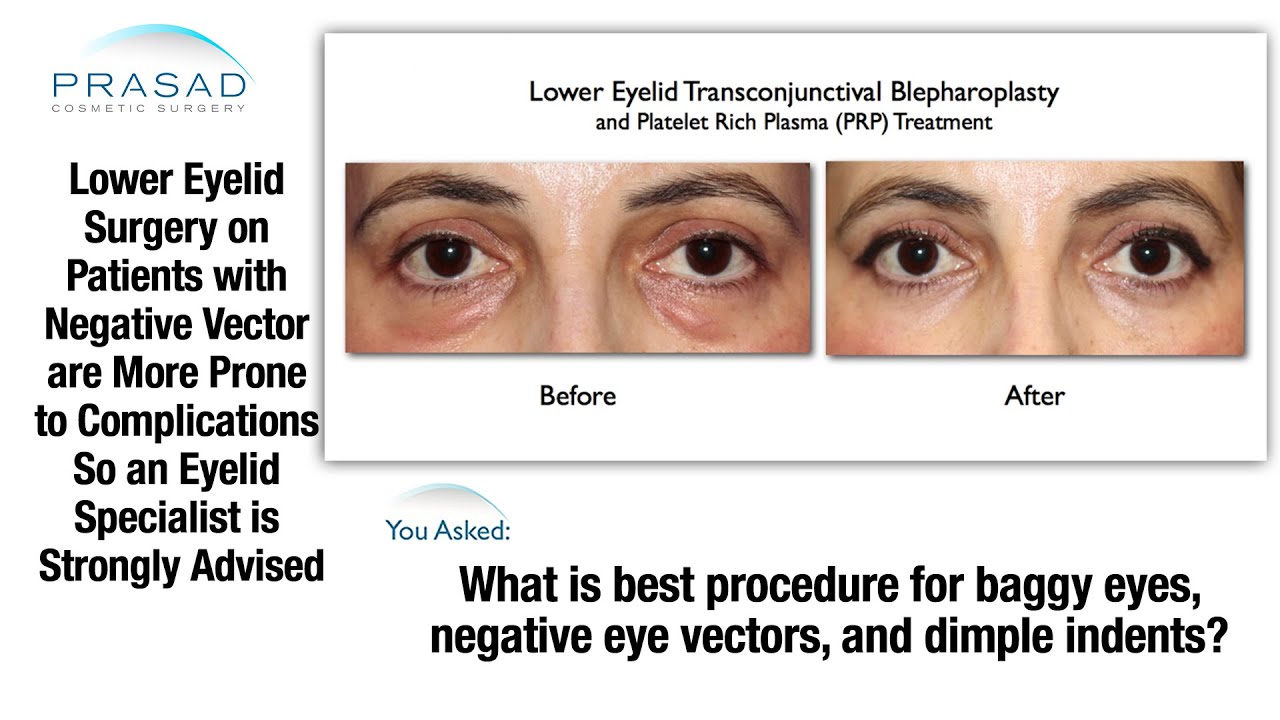 Negative Vector Eye at Vectorified.com | Collection of Negative Vector ...