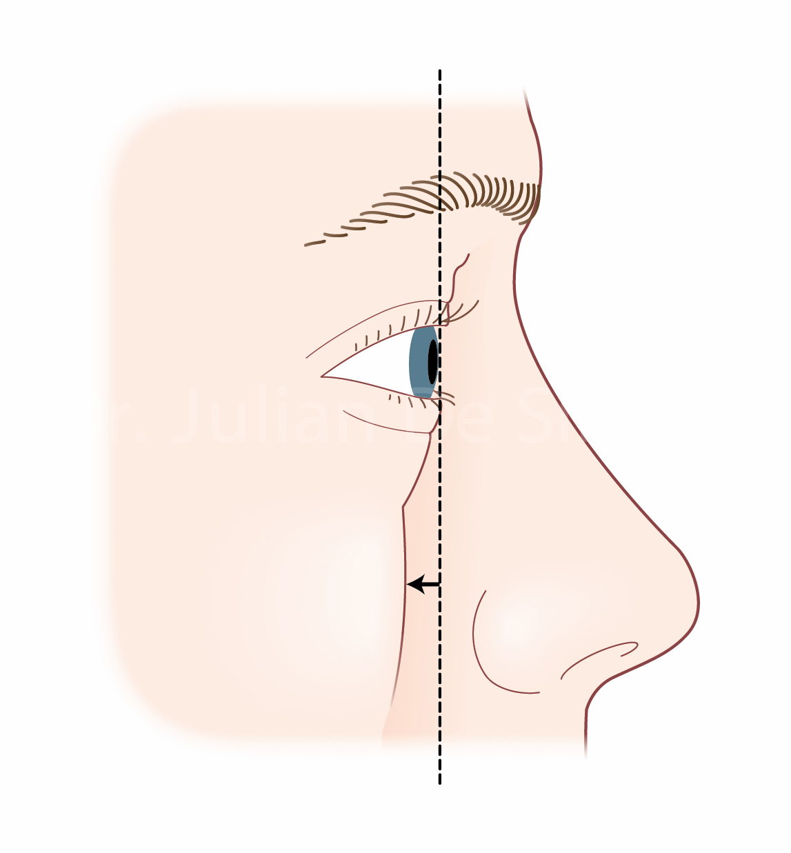 1147x1237 Blepharoplasty Frequently Asked Questions And Answers