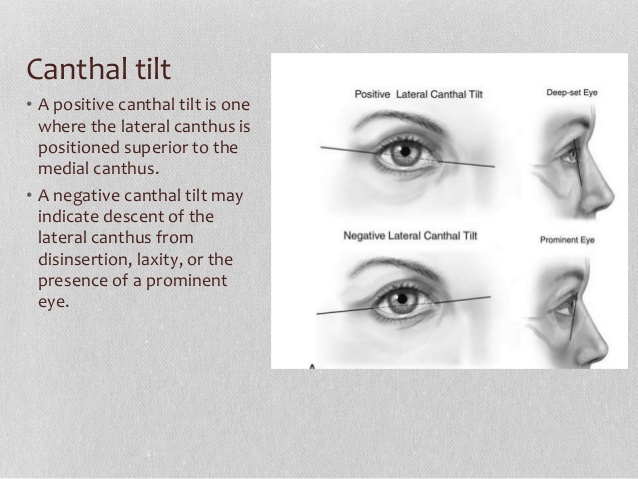 638x479 Blepharoplasty