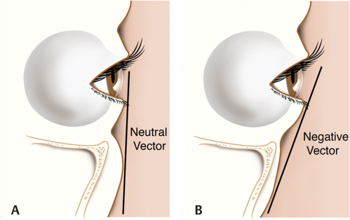 499x314 Complications Of Facial Reanimation Plastic Surgery Key