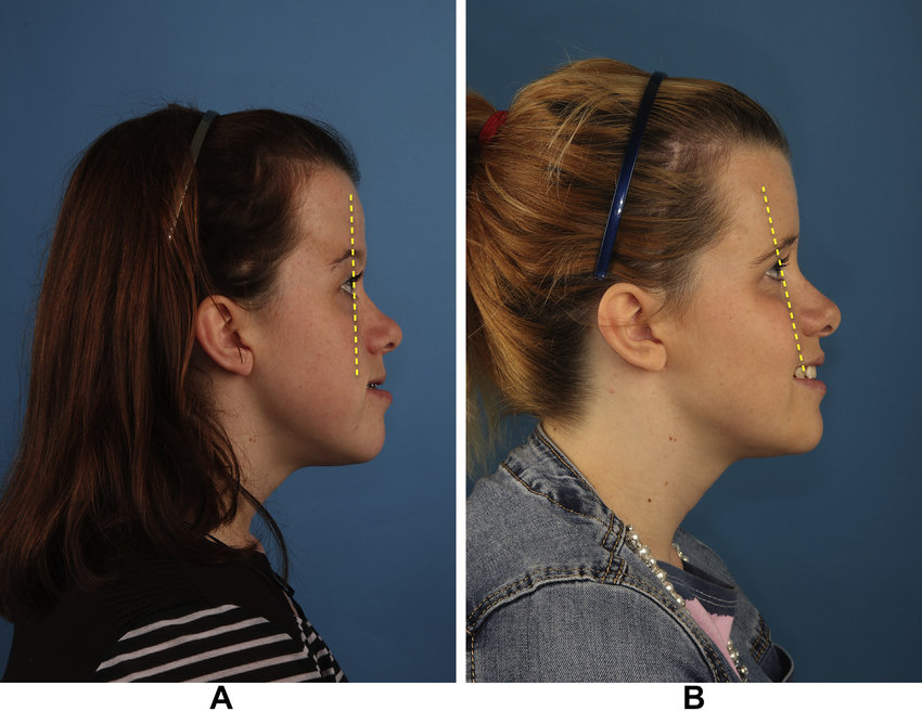 850x656 Profile Views Of Patient With Right Sided Plagiocephaly