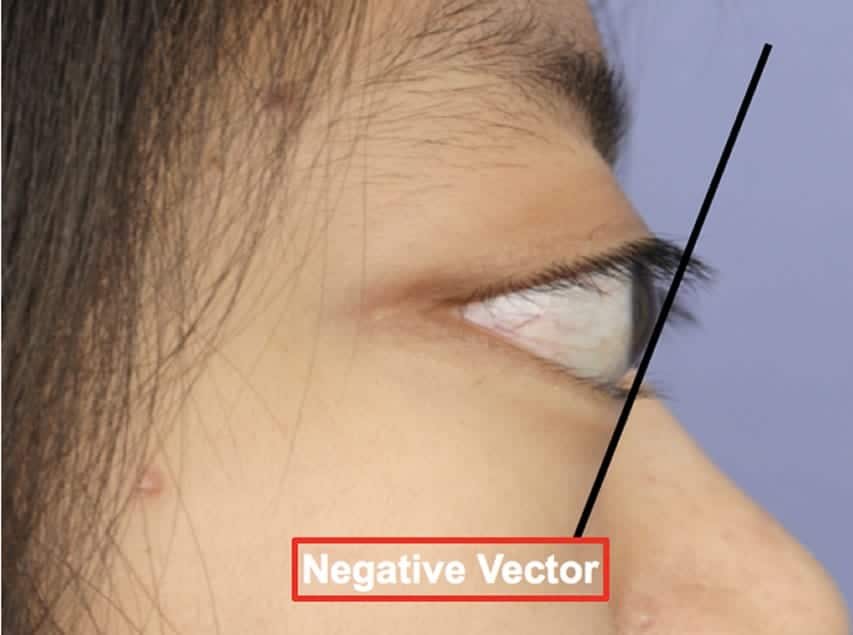 853x635 Eyelid Revision Surgery Eyelid Retraction Beverly Hills