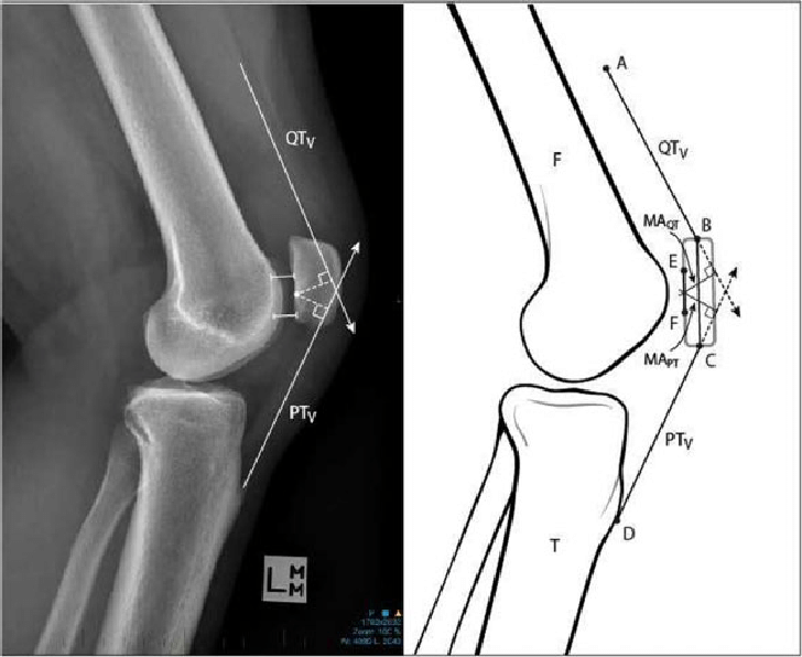 728x596 Moment Arm Ratio Quadriceps Tendon Vector