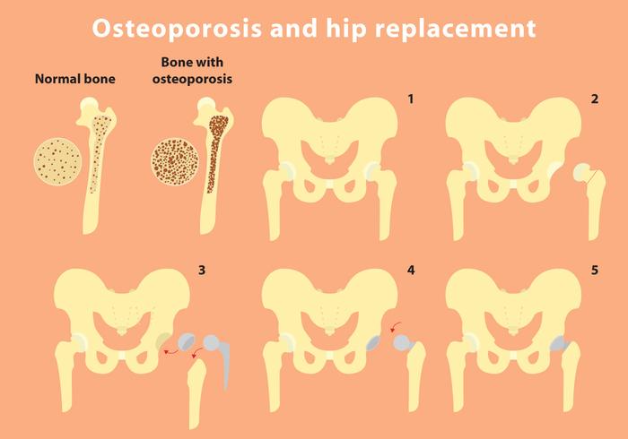 Osteoporosis And Hip Replacement Vector Info 700x490 Osteoporosis And Hip Replacement Vector Info