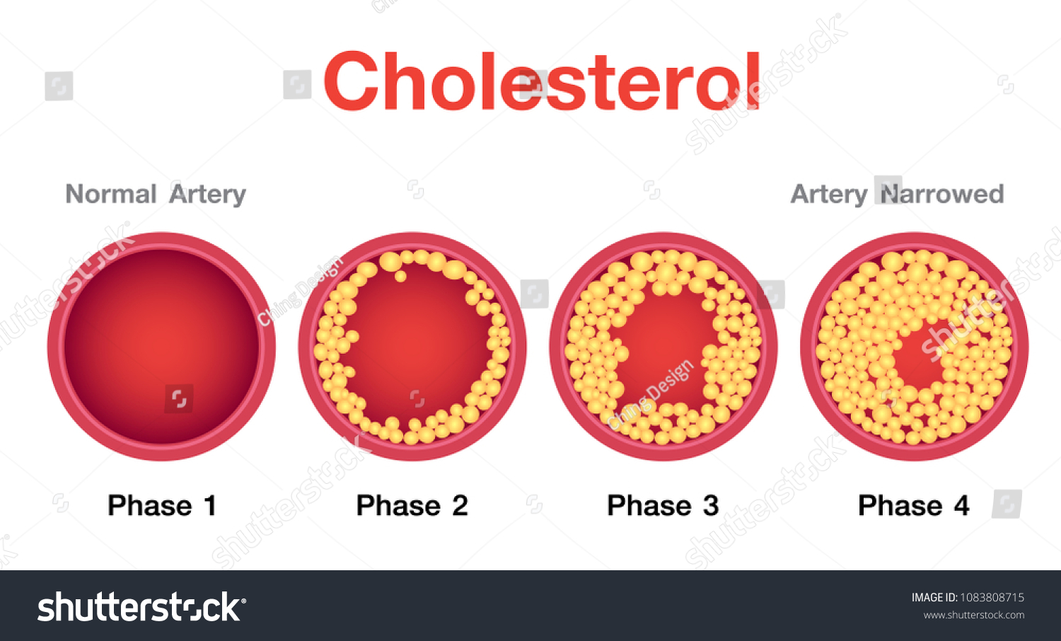 1500x906 Stock Vector Cholesterol In Artery Health Risk Vector Design