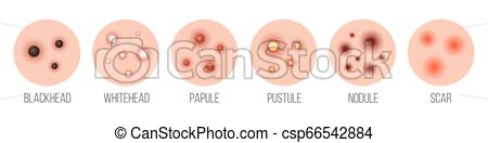 450x132 Creative Vector Illustration Types Of Acne, Pimples, Skin Pores