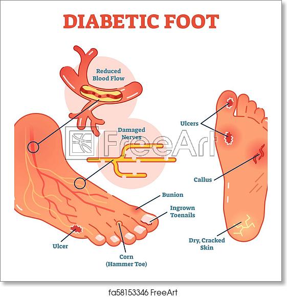 Free Art Print Of Diabetic Foot Medical Vector Illustration Scheme 561x581 Free Art Print Of Diabetic Foot Medical Vector Illustration Scheme