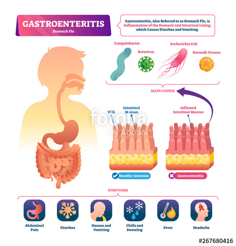 Gastroenteritis Vector Illustration Labeled Stomach Inflammation 481x500 Gastroenteritis Vector Illustration Labeled Stomach Inflammation