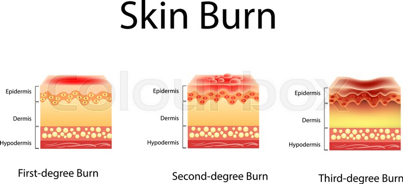 Skin Burn Three Degrees Of Burns Stock Vector Colourbox 800x366 Skin Burn Three Degrees Of Burns Stock Vector Colourbox