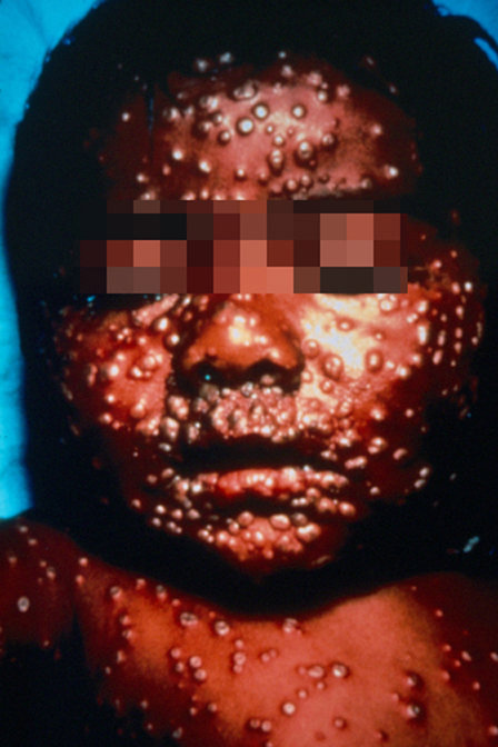 448x672 Smallpox Symptoms, Treatment, Pictures Cause
