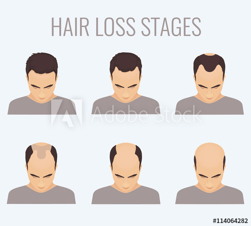 500x450 Male Hair Loss Stages Set Top View Portrait Of A Man Losing Hair