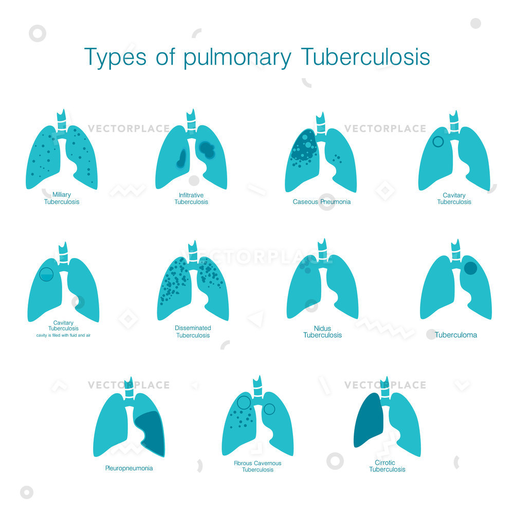 1000x1000 Types Tuberculosis Silhouette Medical Human Body Vector