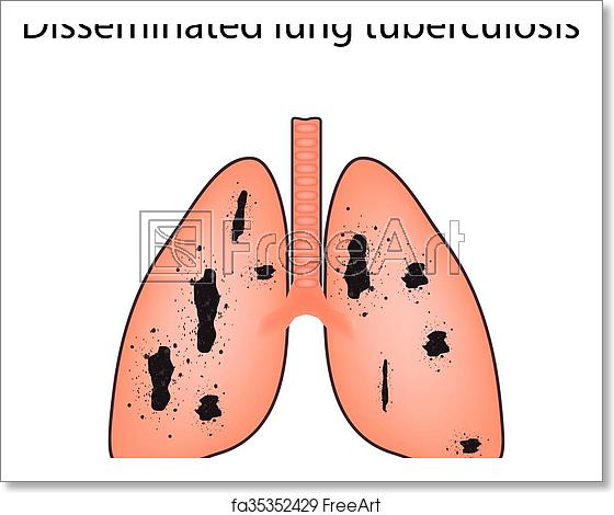 560x470 Free Art Print Of Disseminated Tuberculosis Vector Illustration
