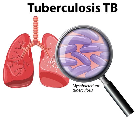 Tuberculosis Vector at Vectorified.com | Collection of Tuberculosis ...