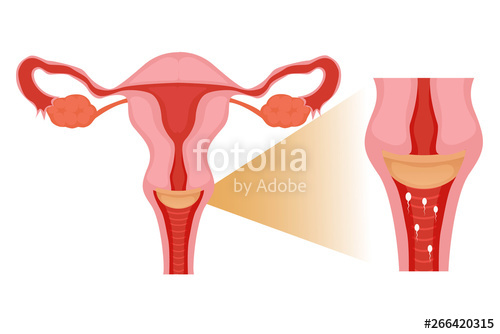 500x334 Diaphragm In The Uterus Vector Illustration Of The Cervical Cap