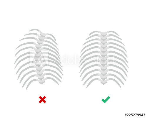 Thoracic Scoliosis On The Thoracic Spine And Straight Backbone 500x400 Thoracic Scoliosis On The Thoracic Spine And Straight Backbone