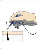 130x164 Vector Electrolysis Hair Removal System