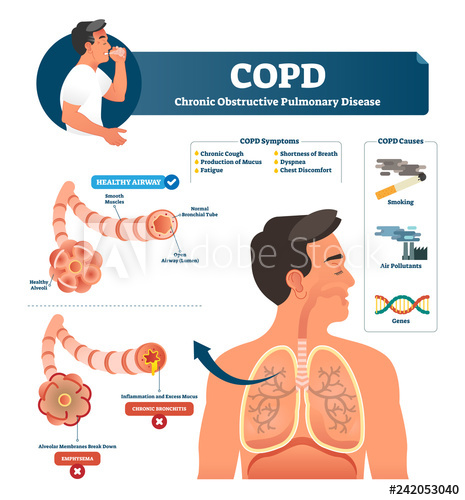 Copd Vector Illustration Labeled Chronic Obstructive Pulmonary 465x500 Copd Vector Illustration Labeled Chronic Obstructive Pulmonary
