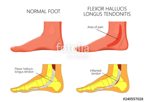 500x350 Vector Illustration Of Healthy Human Foot And A Medial Ankle