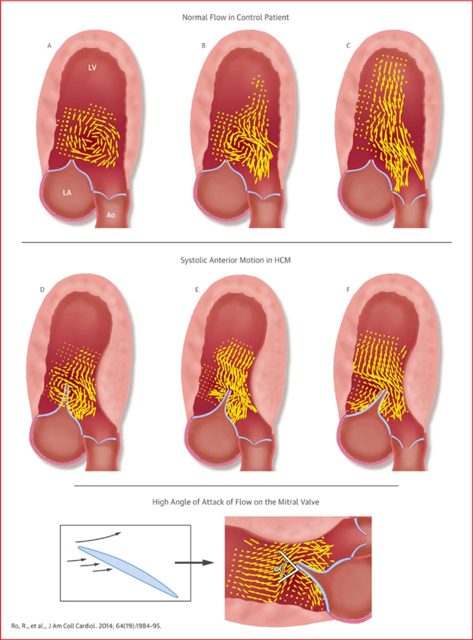947x1280 Vector Flow Mapping In Obstructive Hypertrophic Cardiomyopathy