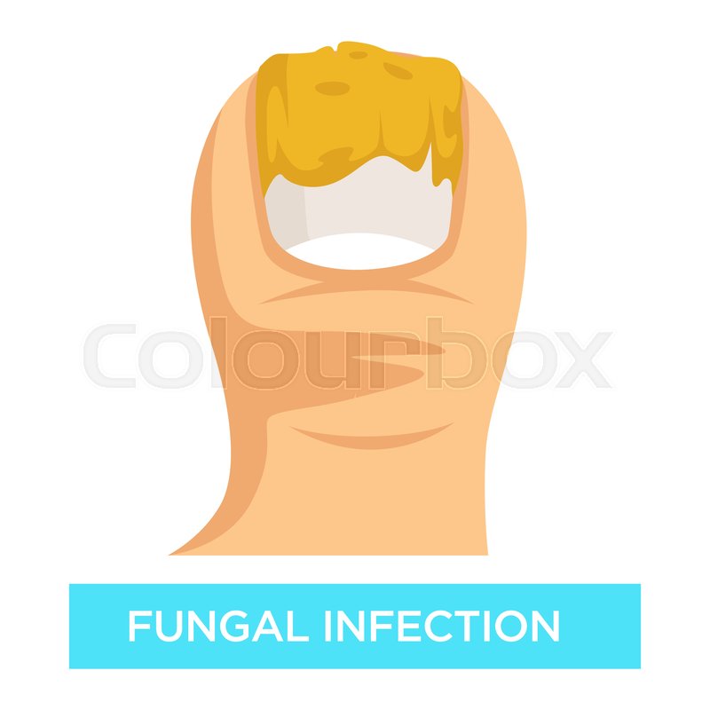 800x800 Toenail Suppuration Fungal Infection Stock Vector Colourbox