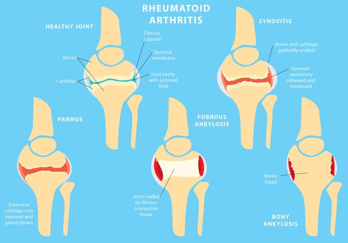 700x490 Joint Rheumatoid Arthritis
