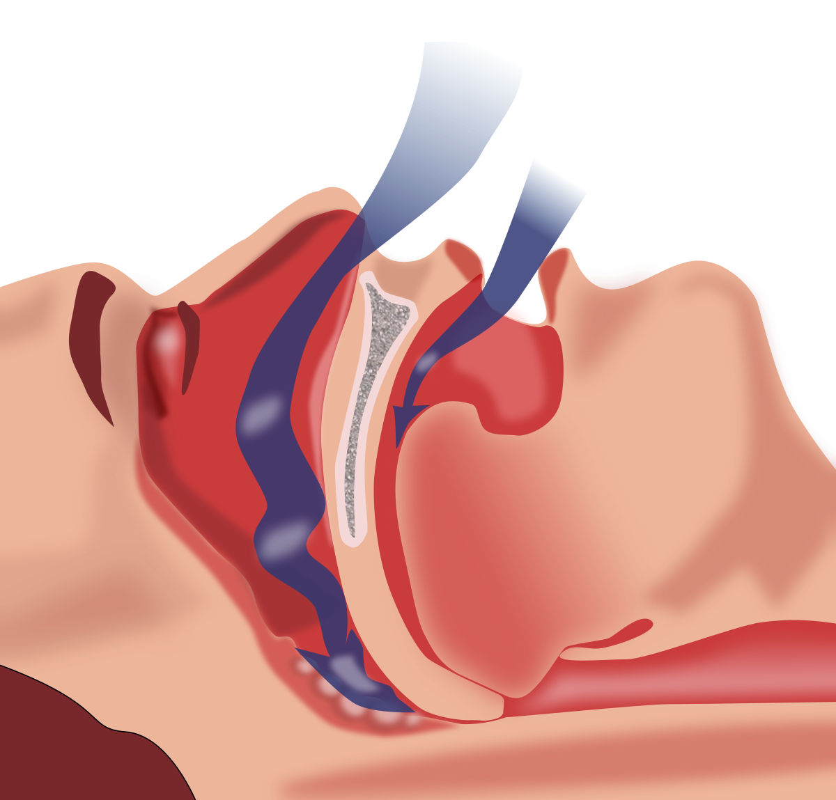 1200x1149 Sleep Apnea