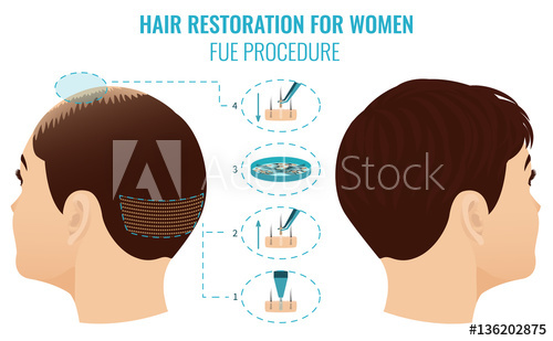 500x309 Female Hair Loss Treatment With Follicular Unit Extraction Stages