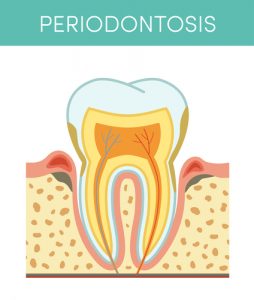 254x300 Root Canal Treatment