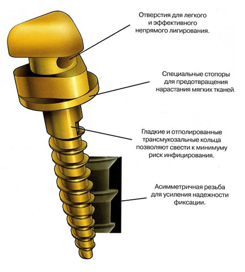 500x554 Mikroimplantatciia Sistemoj Vector Tas