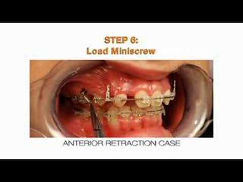 480x360 Vectortas Temporary Anchorage Device