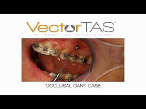 480x360 Vectortas Temporary Anchorage Device Boschken Orthodontics