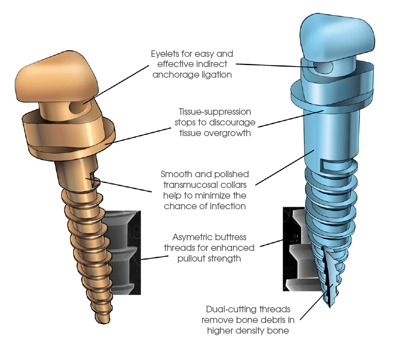 788x699 Temporary Anchorage System Ormco Supplies