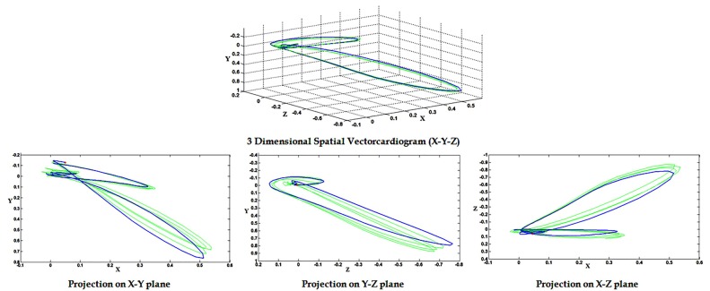Planarity Of The Spatial Qrs Loop Of Vectorcardiogram Is A Crucial 791x325 Planarity Of The Spatial Qrs Loop Of Vectorcardiogram Is A Crucial