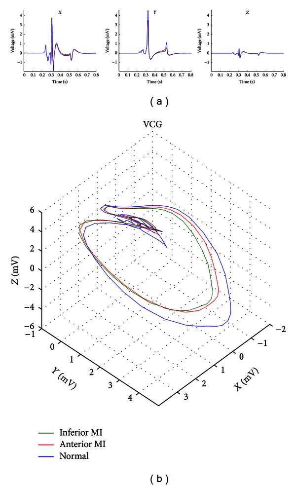600x987 Simulated Vectorcardiogram