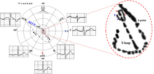 492x238 The Value Of The Vectorcardiogram In Brugada Syndrome